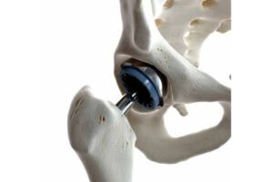 Hip Replacement Recovery: Q&A with a Hip Specialist